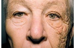 Les ravages des rayons du soleil